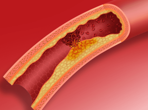 causes-Clogged-arteries clogged arteries