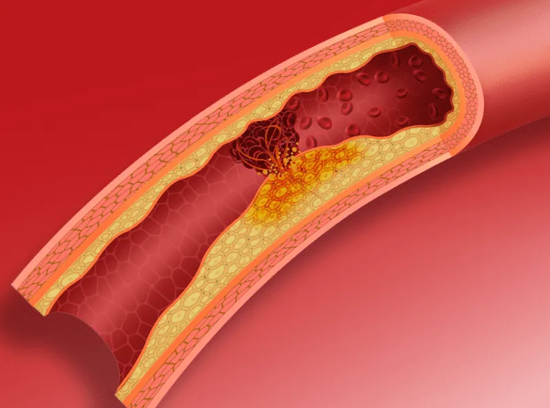 causes-Clogged-arteries clogged arteries