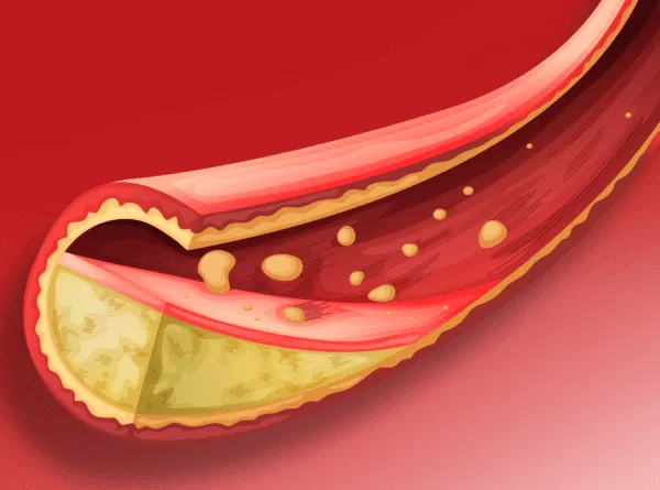 causes-High-Cholesterol High Cholesterol