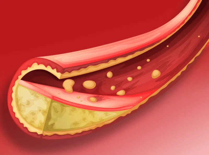 causes-High-Cholesterol High Cholesterol